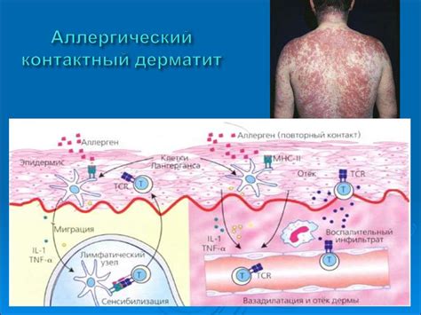 Аллергические реакции и непереносимость лекарств