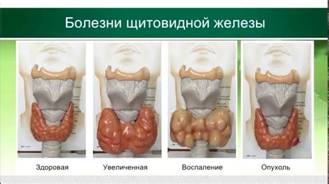 Альтернативные методы лечения гипотиреоза щитовидной железы