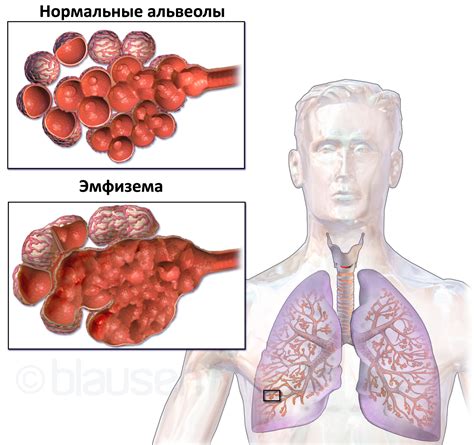 Анализ проблемы эмфиземы легких