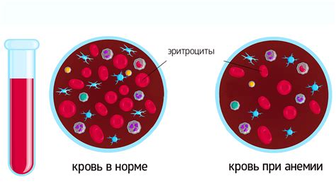 Анемия как одна из причин