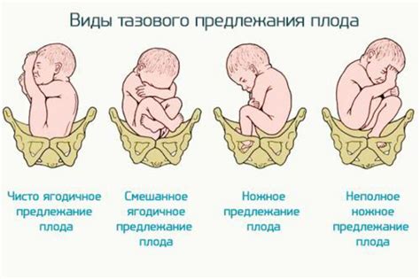 Аномалии положения плода