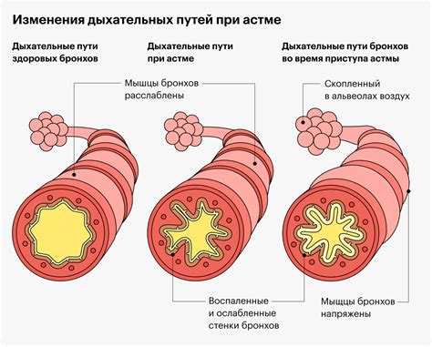 Астма и кроводача