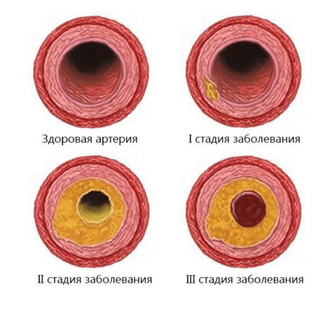 Атеросклероз сосудов