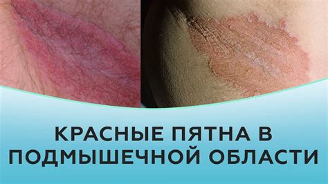 Белые или ярко-красные пятна в кале - сигнал о наличии бактерии H.pylori в желудке