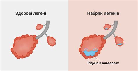 Болезни сердца и легких