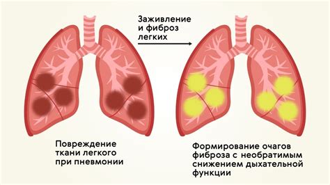 Виды базальных отделов легких