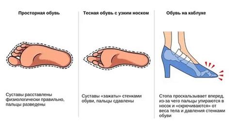 Влияние неправильной обуви на костную ткань