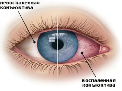 Возможные осложнения и последствия у пациентов с выпученной глазницей