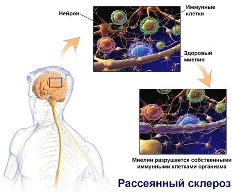 Восстановление миелиновой оболочки при рассеянном склерозе: опыт пациентов