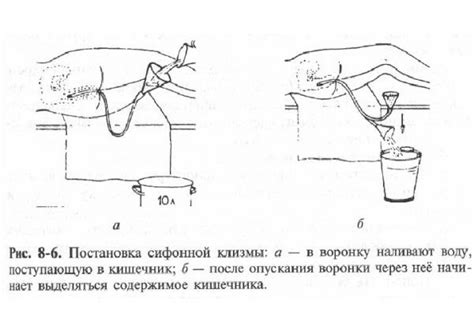 Выбор раствора для сифонной клизмы