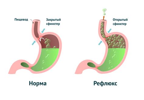 Газы в животе: причины