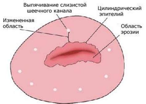 Генетическая предрасположенность и эрозия шейки матки