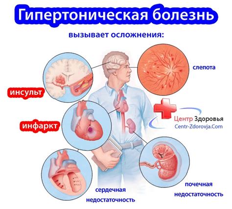 Гипертоническая болезнь: