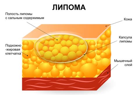 Диагностика жировика: методы и процедуры