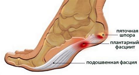 Диагностика и лечение боли в пятке