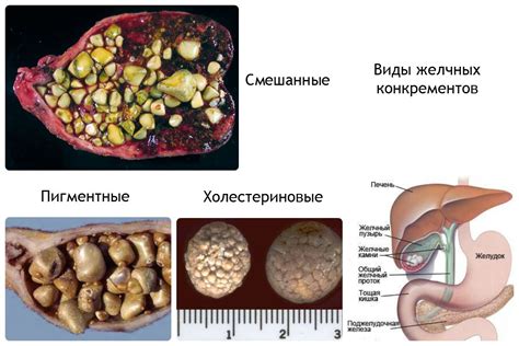 Диагностика камня в желчном пузыре