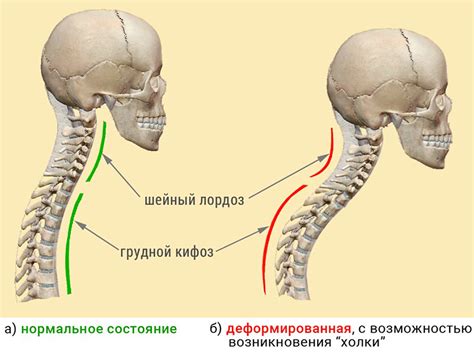 Диагностика лордоза шейного отдела