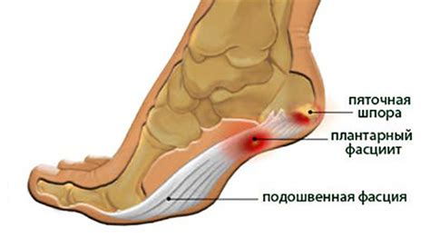 Диагностика сильной боли в пятке