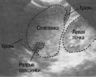 Диагностика увеличенной селезенки у ребенка 3 лет