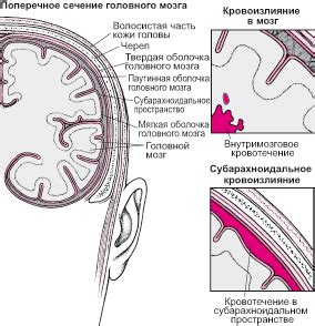 Заболевания, спровоцировавшие кровоизлияние