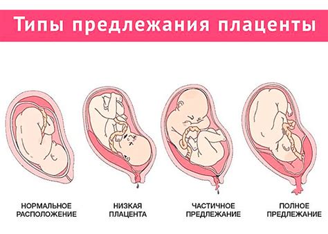 Запрещенные действия при предлежании плаценты