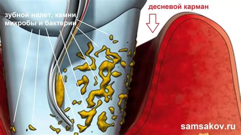 За что отвечают десневые карманы