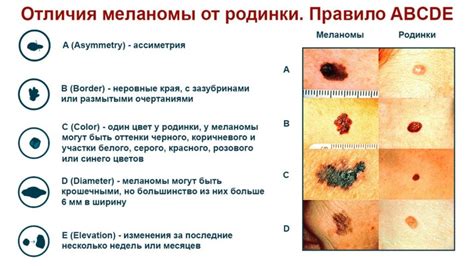 Значение родинки на ключице