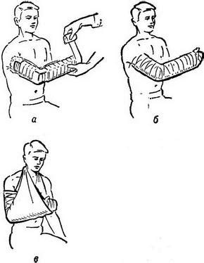 Иммобилизация пораженной конечности