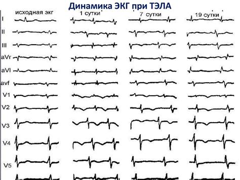 Интерпретация ЭКГ при учете дыхательного цикла