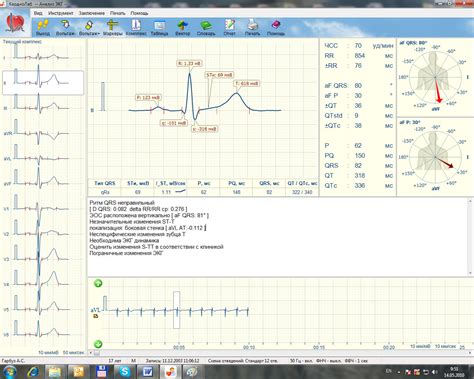 Интерпретация результатов ЭКГ