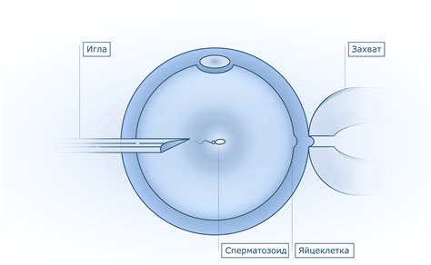 Интрацитоплазматическая спермиоинъекция (ИКСИ)