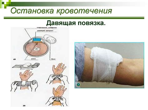 Использование жгута для остановки венозного кровотечения