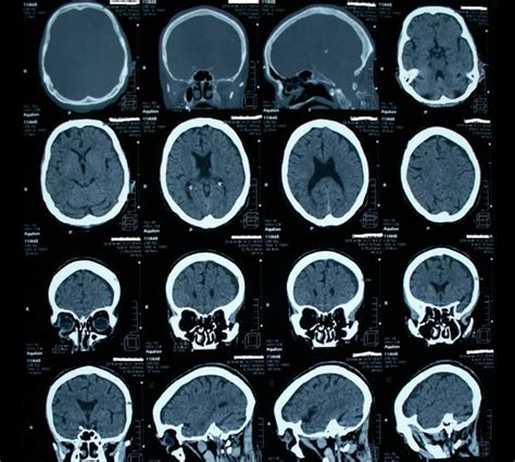 Какие данные предоставляет компьютерная томография при сотрясении мозга