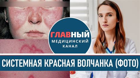 Какие признаки указывают на наличие красной волчанки у мужчин?