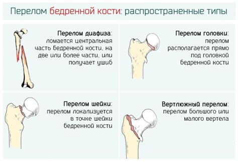 Какие причины лежат в основе переломов шейки бедра у пожилых?