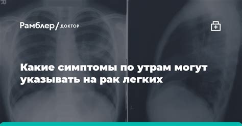 Какие симптомы могут указывать на необходимость КТ легких?