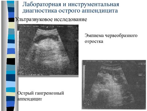 Как выявить аппендицит у ребенка