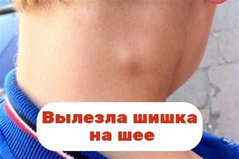 Как определить наличие шишки на шее