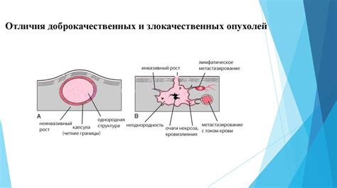 Как определить рак от доброкачественной опухоли: основные признаки