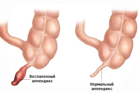 Как отличить аппендицит от других заболеваний