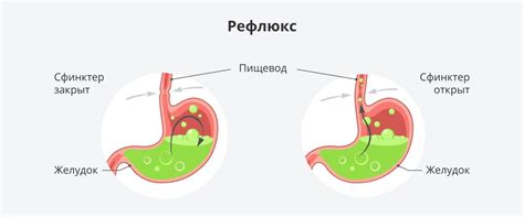 Как предотвратить выброс желчи в гортань