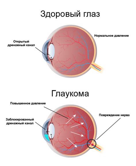 Как проявляется симптом выпученности глаз в клинической картине