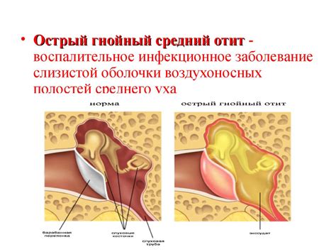 Как различить гнойный отит от других заболеваний уха