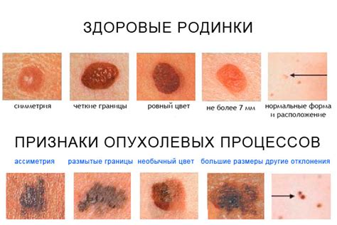 Как распознать жировик на ранней стадии