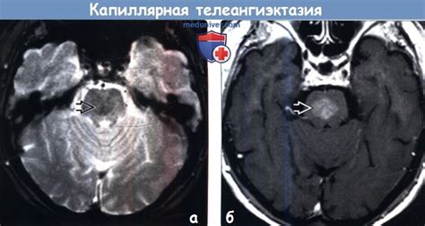 Капиллярная телеангиэктазия головного мозга