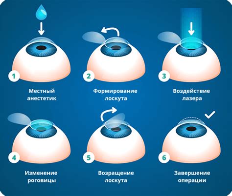 Кто подходит для лазерной коррекции зрения