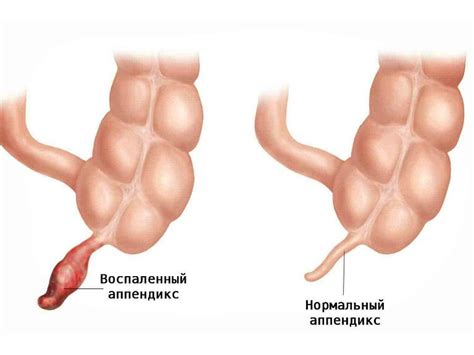 Лечение аппендицита: операция и нехирургические методы