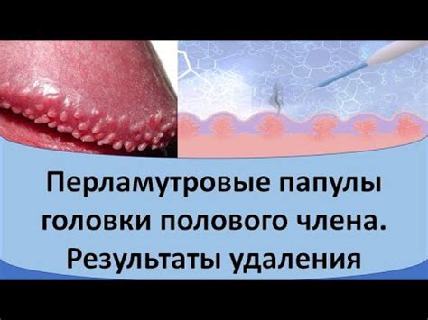 Лечение уздечки на половом органе мужчины