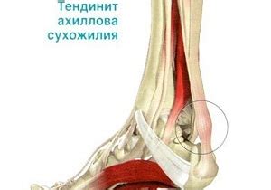 Лечение укороченного ахиллова сухожилия: эффективные методы