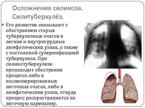 Методы диагностики силикоза легких